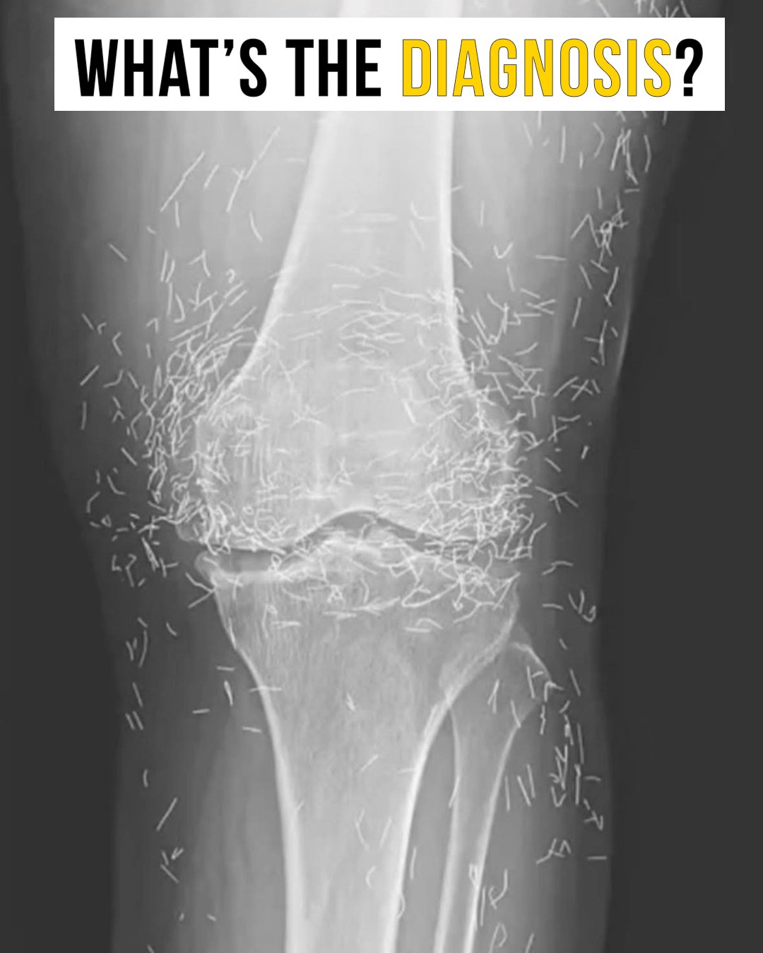 Doctors Discover Unexpected “Gold Deposits” in Patient’s Knees: A Real Case That Highlights Risks and Lessons in Alternative Treatments