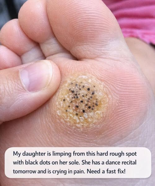 My Daughter Has a Painful Spot on Her Foot Before Her Dance Recital — What Can I Do Fast?